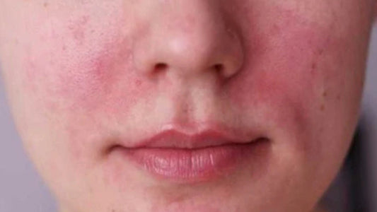 Cómo tratar la rosácea: rutina simple para calmar la rojez